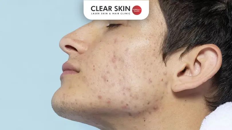 Can Masturbation Cause Acne? Expert Advice for Clearer Skin!