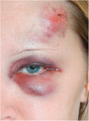 Got an after fight face? Discover the best methods for healing bruises and cuts safely.