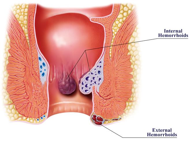 What are the main risks of anal sex without a condom? Learn about STIs and potential physical harm.