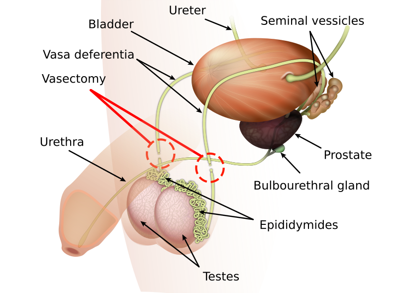 Need a Vasectomy? Who Does Vasectomy Near Me & Is Trusted?