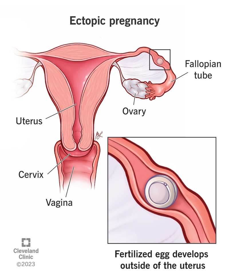 Who is at Risk for an Ectopic Pregnancy? Important factors and common causes everyone should know about.