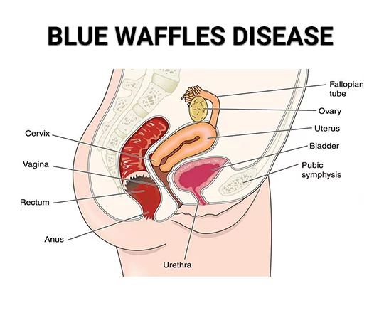 Are blue waffles safe? What you need to know