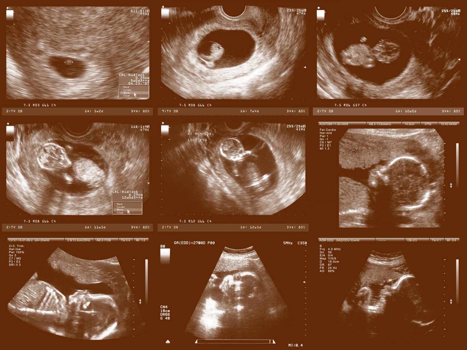 What amazing things can ultrasonidos de embarazo show? Seeing your babys detailed growth with these pregnancy scans.