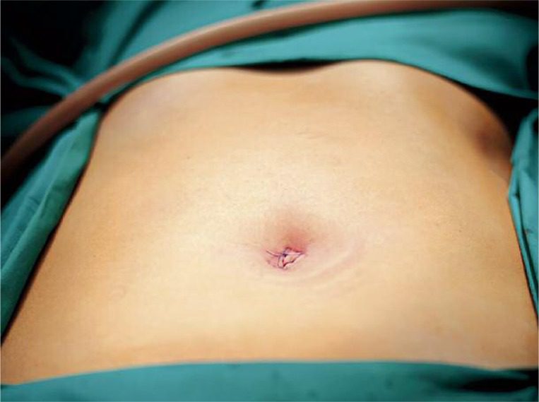 Will my ligadura de trompas cicatriz be obvious? Learn what influences your tubal ligation scar visibility.