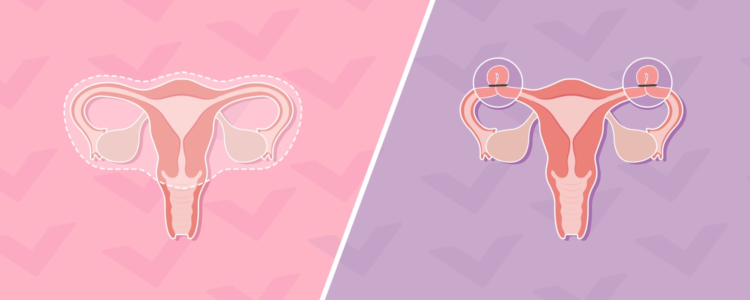 Tubal Ligation vs Hysterectomy: Pros and Cons to Consider (Helping You Make an Informed Health Choice)
