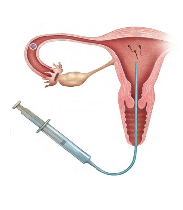 Where to find inseminacion near me, cost and details?