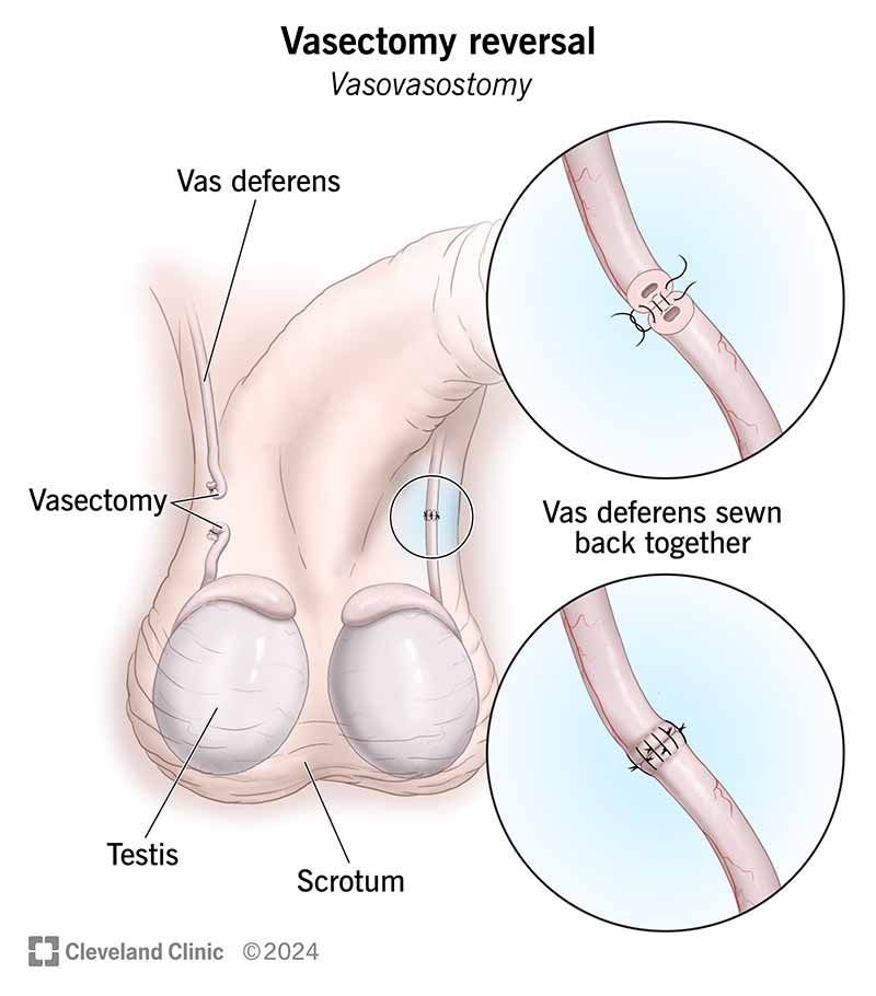 Wondering how much does a vasectomy reversal cost? Lets explore the average costs and available payment options together.