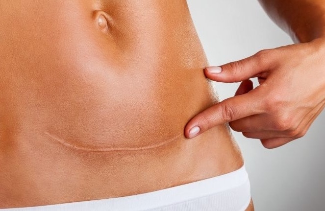 Will my ligadura de trompas cicatriz be obvious? Learn what influences your tubal ligation scar visibility.