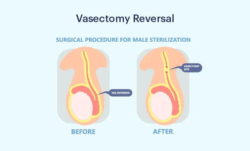 Wondering how much does a vasectomy reversal cost? Lets explore the average costs and available payment options together.