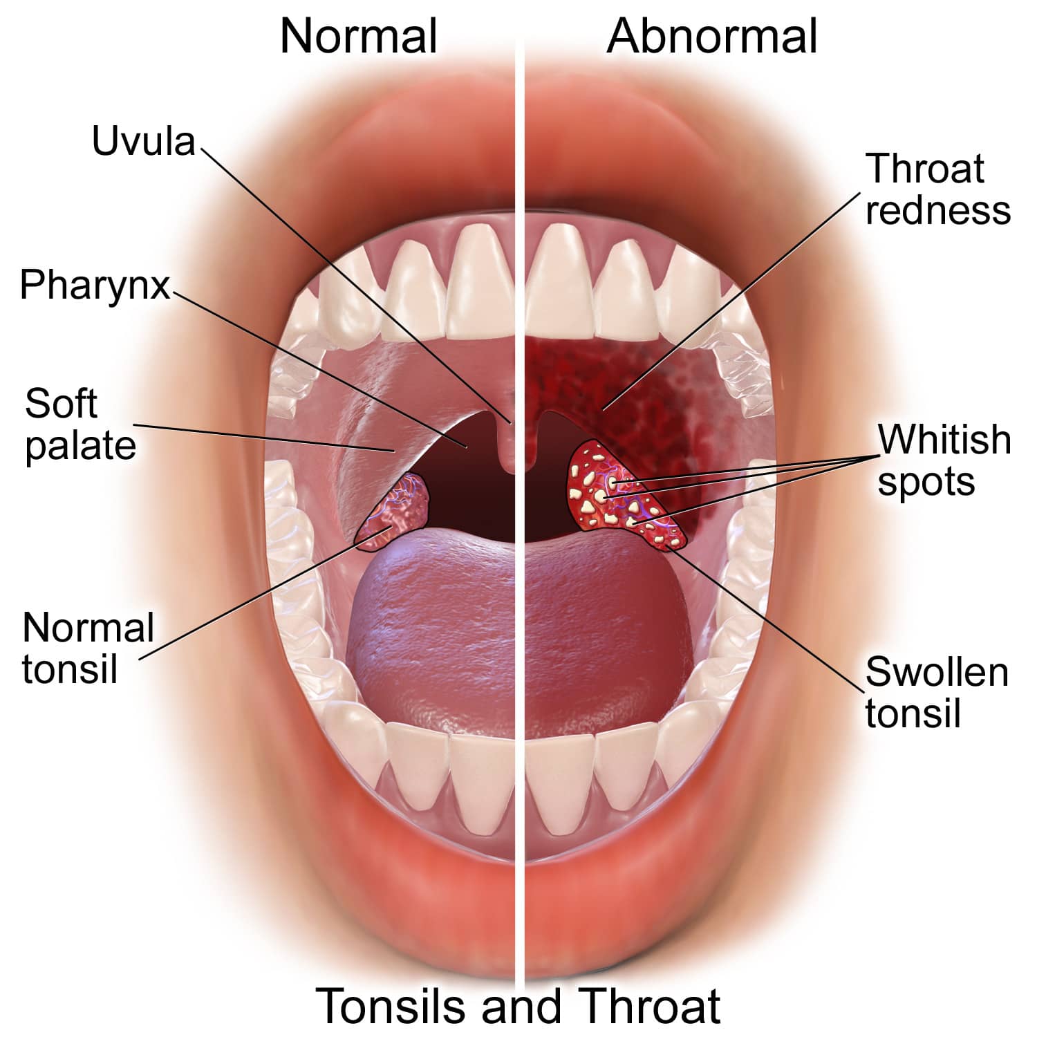 Thinking about intimacy despite strep throat? Heres what happens if you give oral with strep throat.