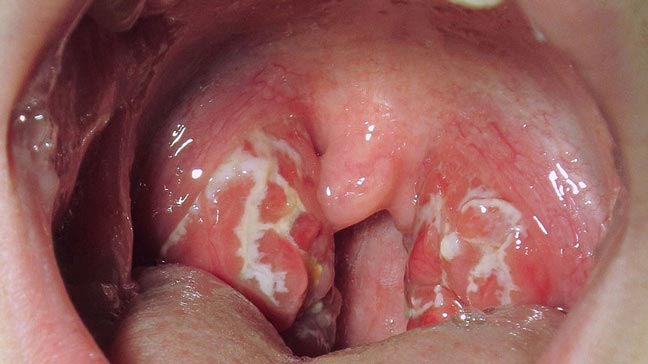 Thinking about intimacy despite strep throat? Heres what happens if you give oral with strep throat.