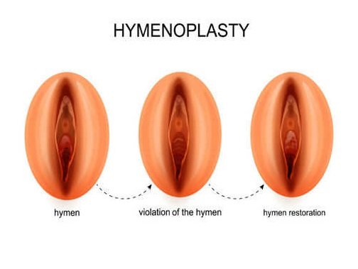 Can U Get Your Virginity Back? Doctor Explains Simple Medical Views