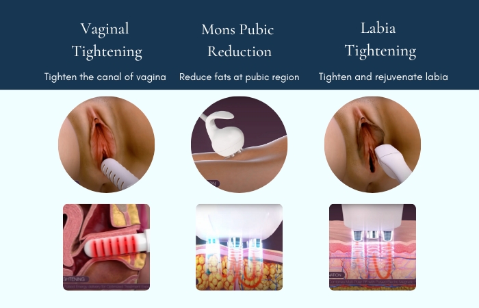 How to tight vergina without surgery discover simple proven methods