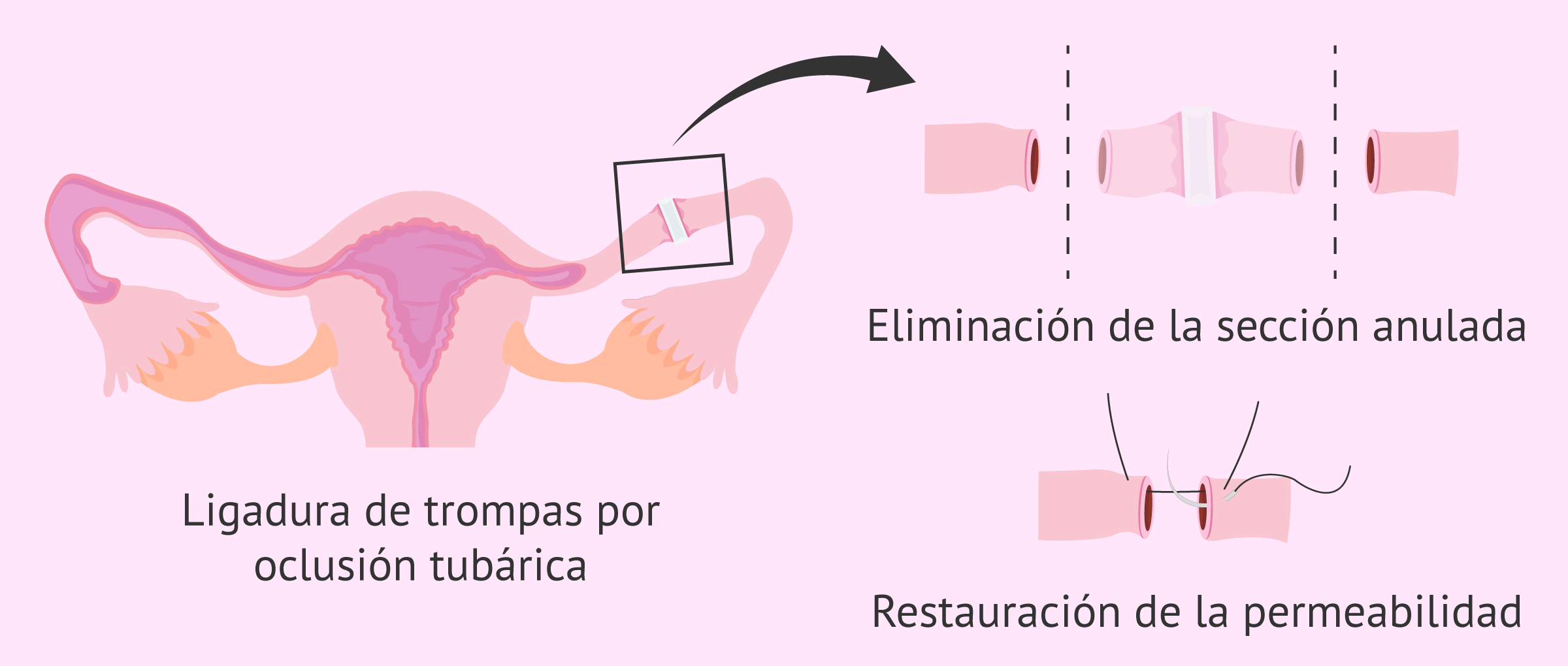 Worried if se pueden desligar las trompas solas? Understand the real risks and probabilities now!