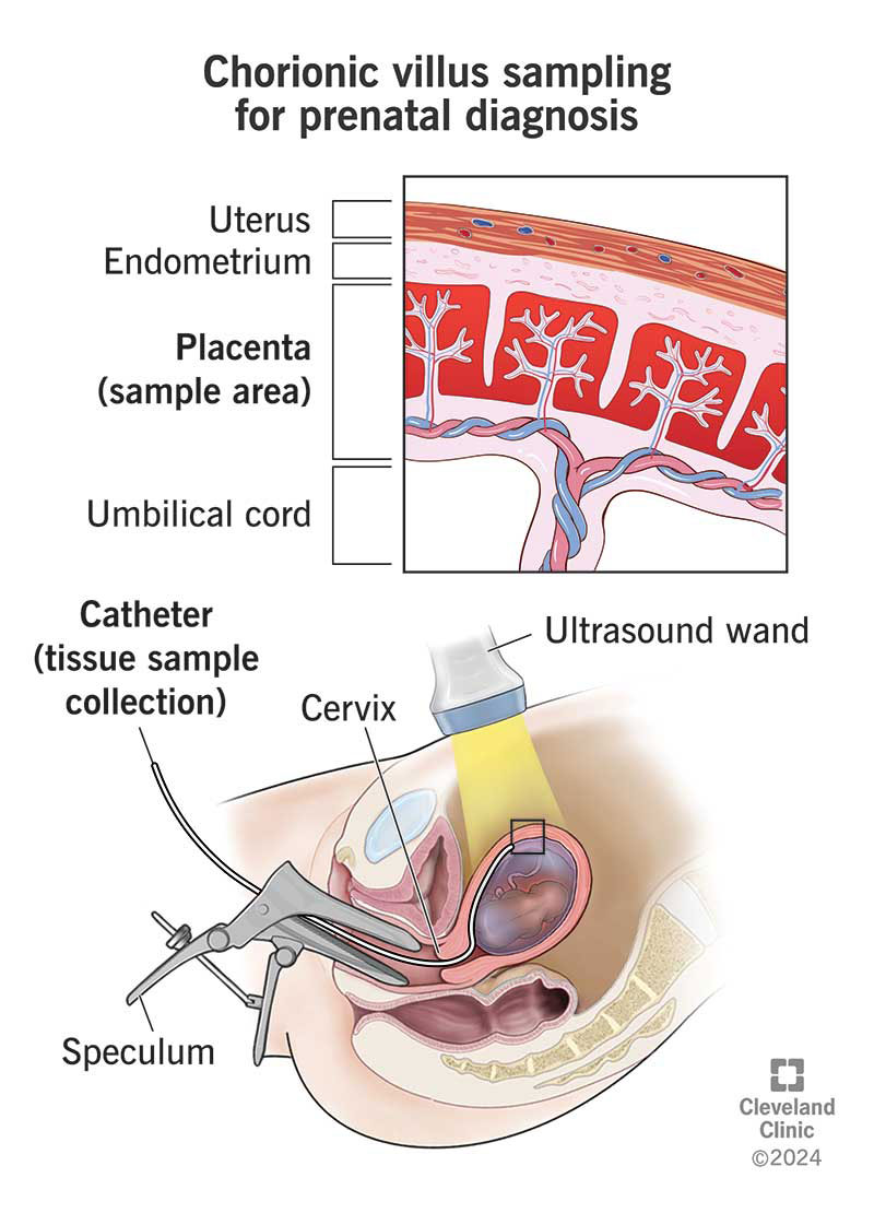 Chorionic Villus Sampling Near Me: Find Local CVS Options Now