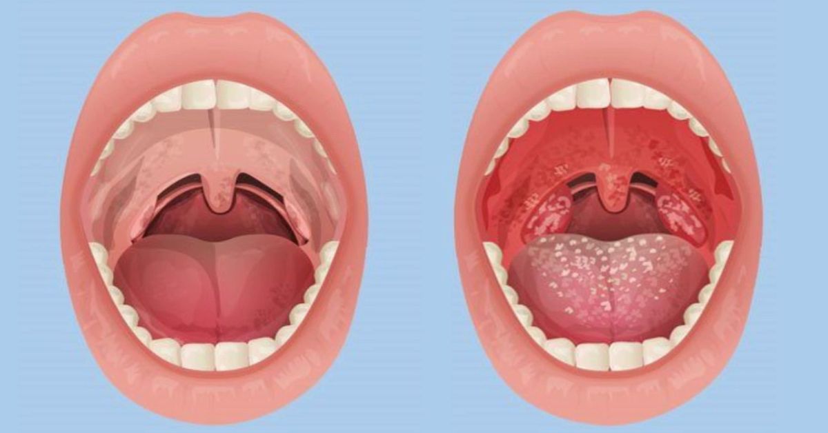 Is it strep throat or oral gonorrhea? Discover simple ways to find out whats really wrong.