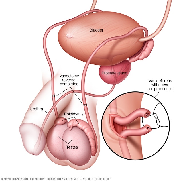 La vasectomia es reversible: Is this really true? Get simple facts on vasectomy reversal now!