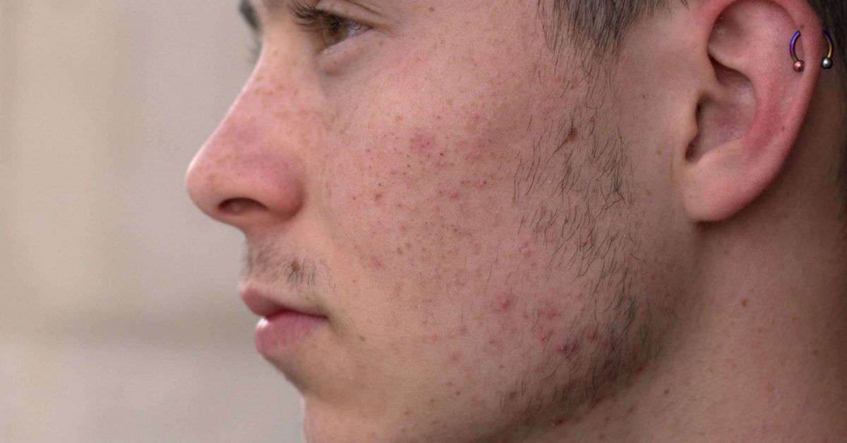 Worried about acne masturbation affecting your skin? Heres what you simply need to know about it.
