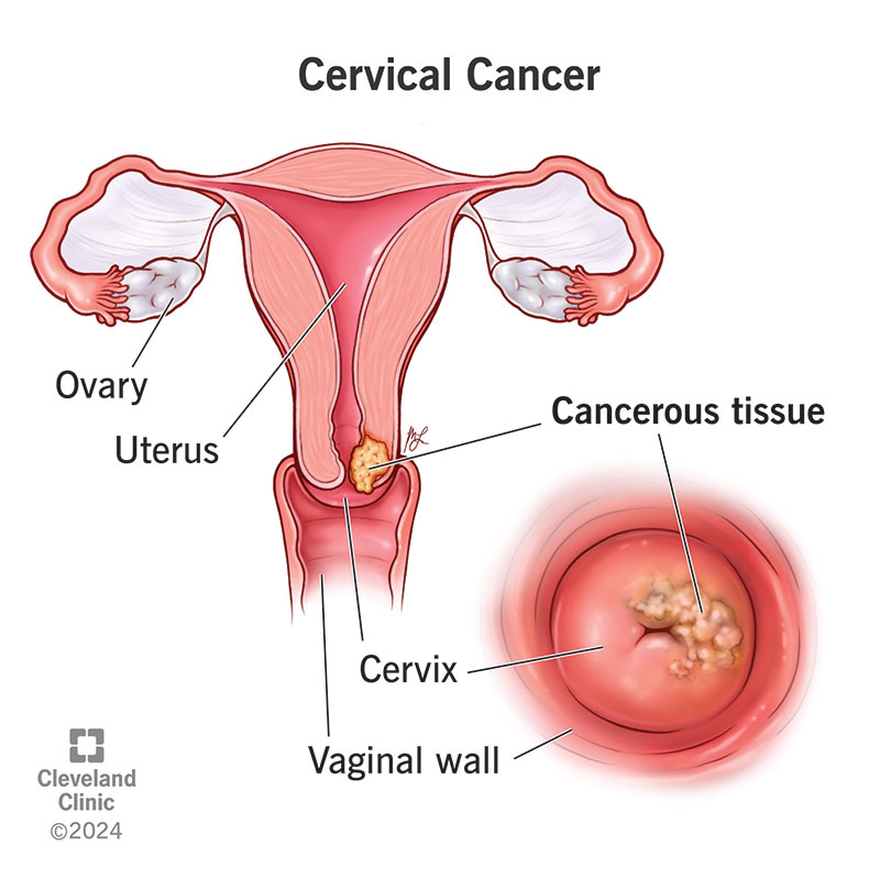 Is cervical cancer curable? Yes! Find out the key ways doctors treat it successfully now.