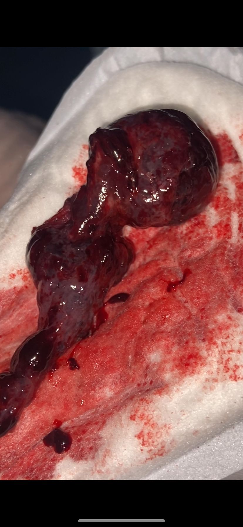 7 weeks pregnant miscarriage pictures need help understanding these photos