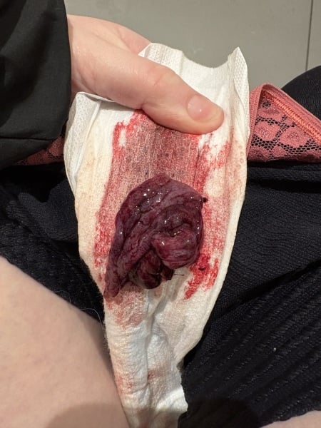 pics of miscarriage at 7 weeks safe ways to view and get support help