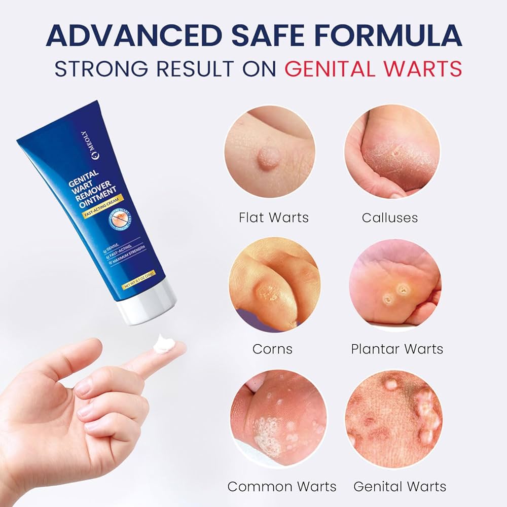 How to Use Genital Warts Cream? Learn How to Remove Genital Warts Fast!