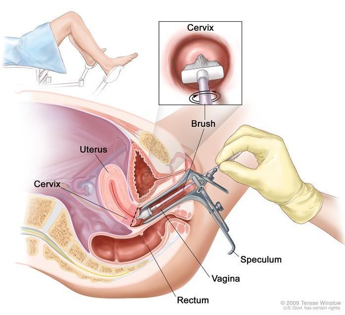 Why Cant a Pap Smear Detect Herpes? Key Reasons Explained Fast.