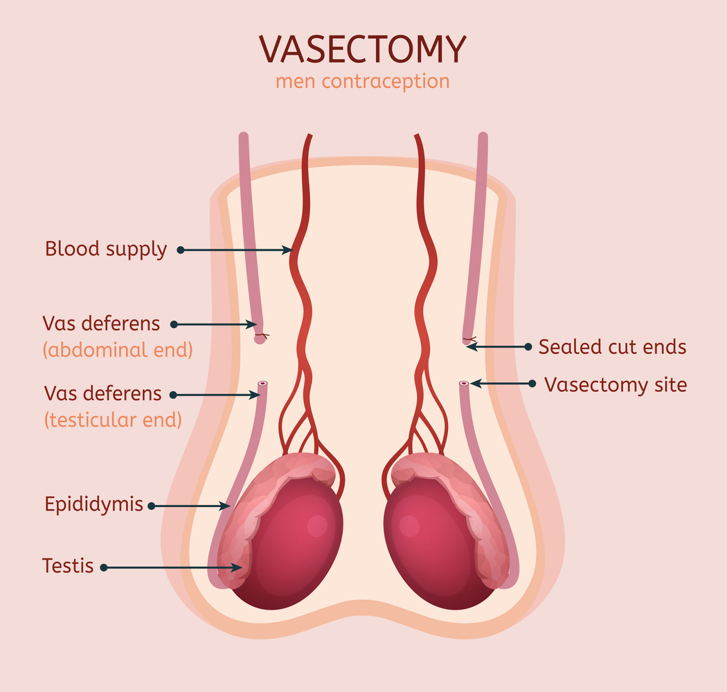 How Soon Can I Schedule Vasectomy Near Me (Clinics With Openings)