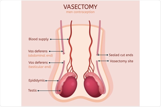 Vasectomy Covered by AHCCCS? Learn How to Get Approved Now.