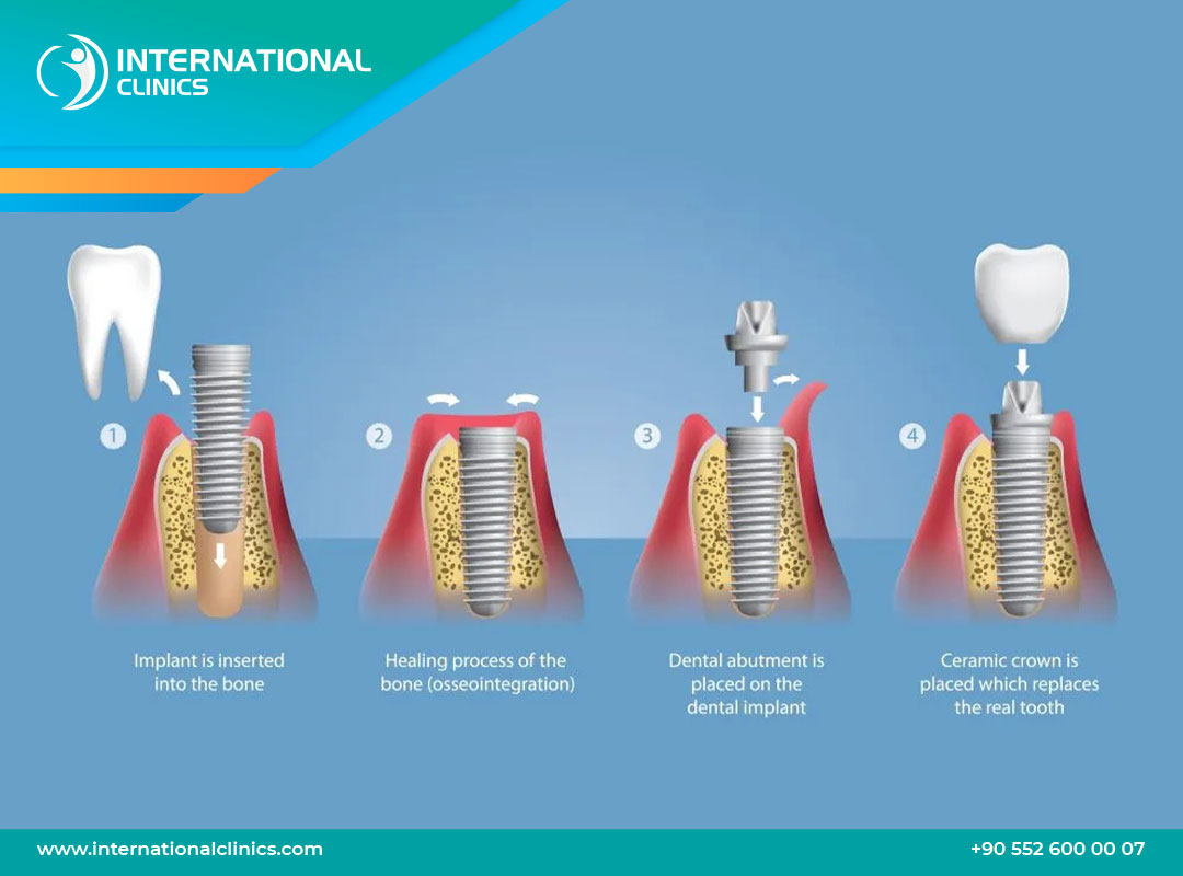 How long does implant take? Understand each process stage and how long it lasts.