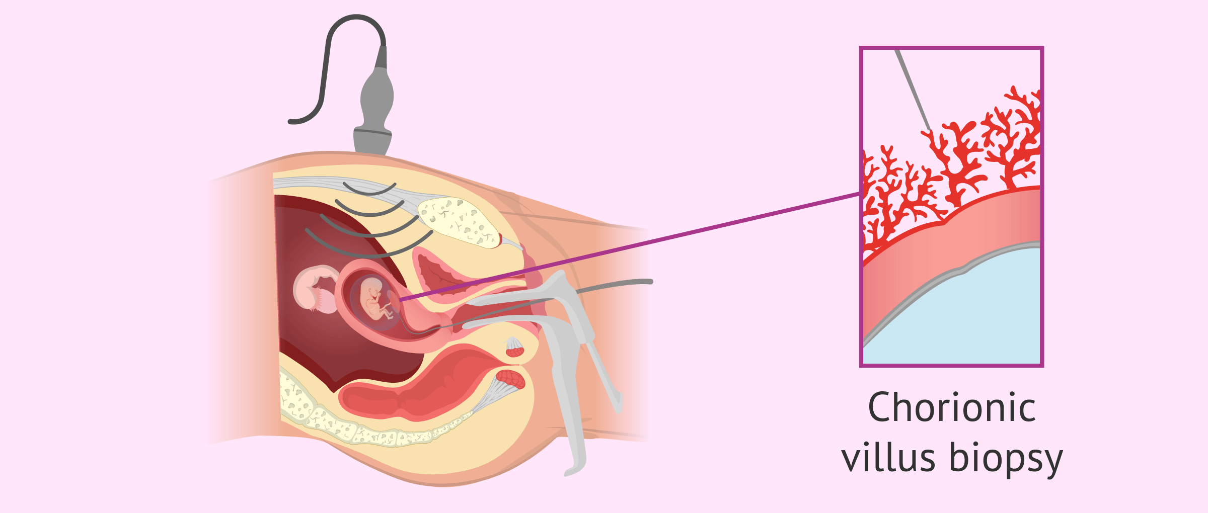 What Affects Chorionic Villus Sampling Cost Get the Facts