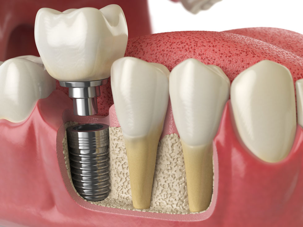 How long does implant take? Understand each process stage and how long it lasts.